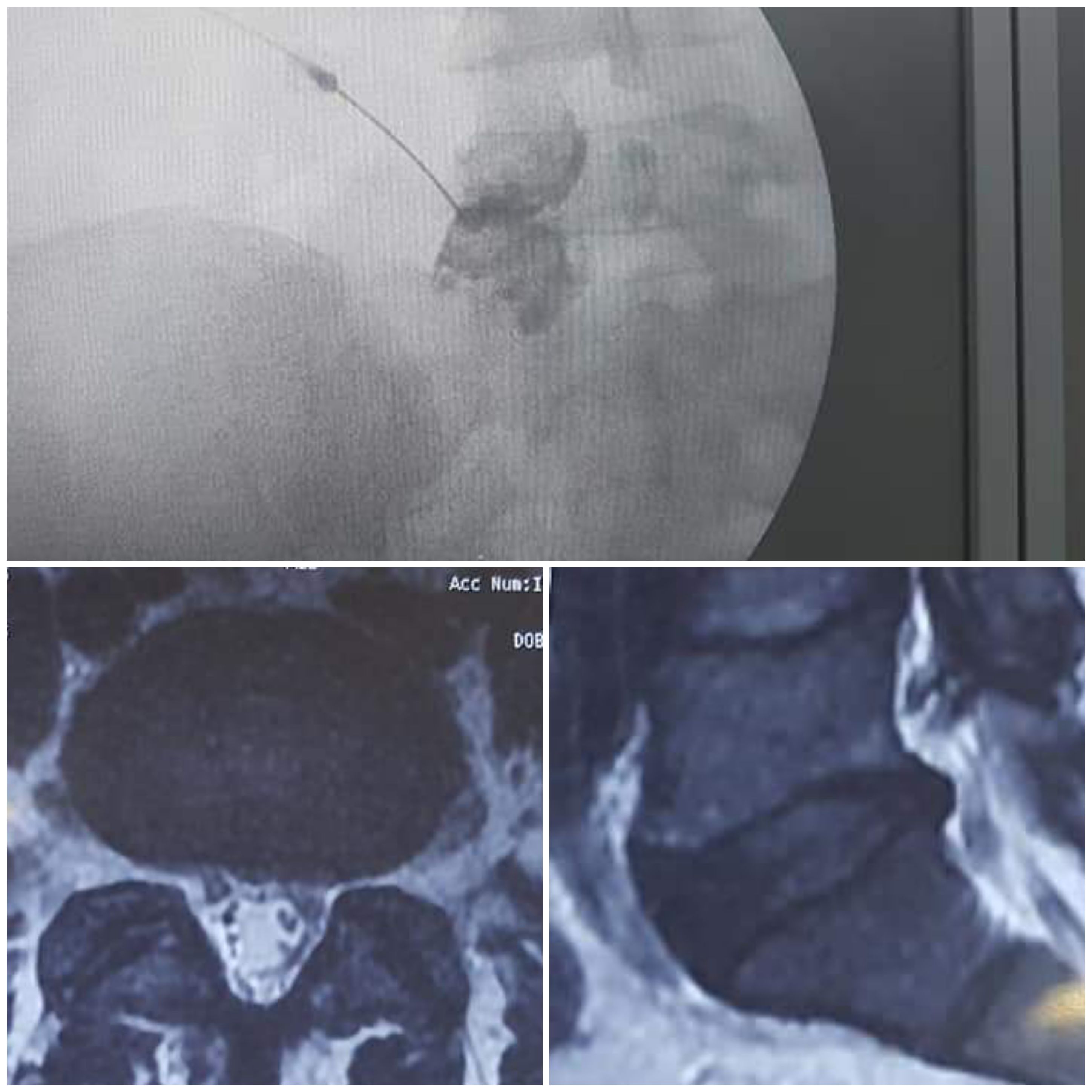 lumbar disc bulge treated by epidyral neuroplast and epidural steroid injection.jpg